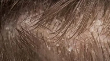 قشرة الرأس الرطبة: أسباب ظهورها وكيفية علاجها بفعالية